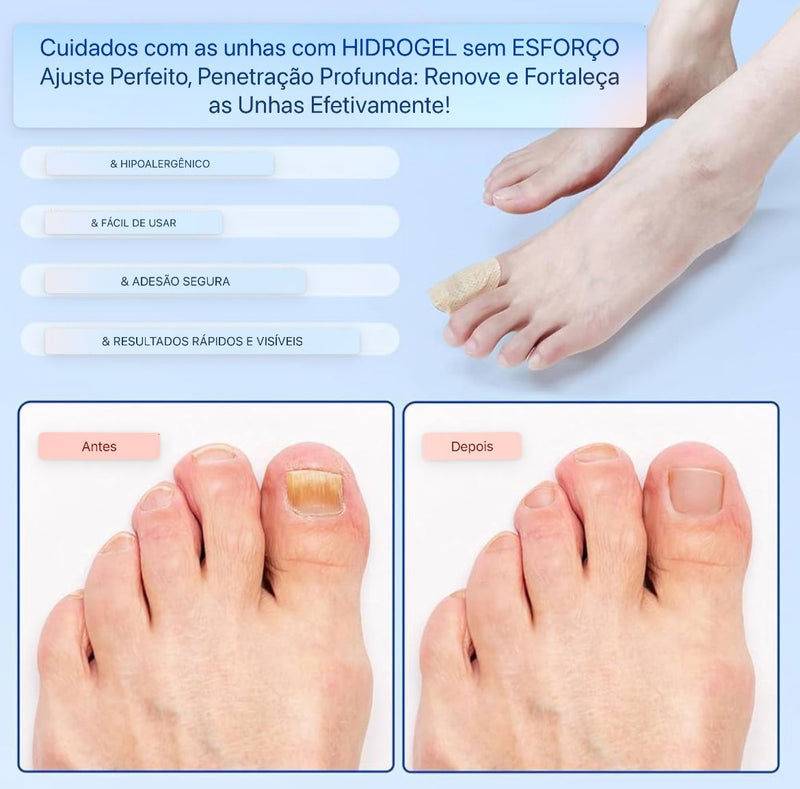 Adesivos Antifúngicos Para Tratamento De Unhas , Reparos De Onicomicose - Sempre Acessível
