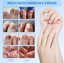 Adesivos Antifúngicos Para Tratamento De Unhas , Reparos De Onicomicose - Sempre Acessível