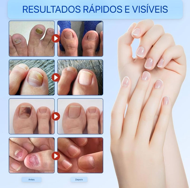Adesivos Antifúngicos Para Tratamento De Unhas , Reparos De Onicomicose - Sempre Acessível