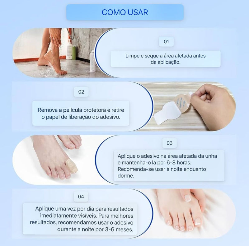 Adesivos Antifúngicos Para Tratamento De Unhas , Reparos De Onicomicose - Sempre Acessível